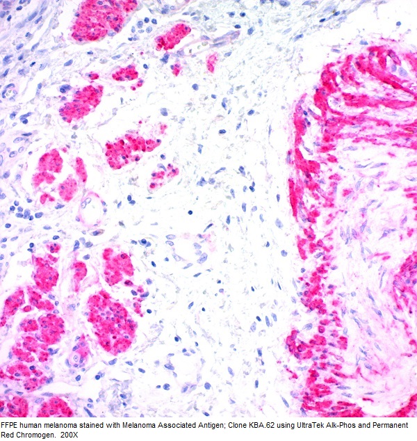 Melanoma Associated Antigen; Clone KBA.62 (Ready-To-Use)